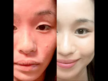 アトピーや乾燥肌で自己肯定感の低い人が、たった1ヶ月で艶肌になる! / 長谷川 やよい
