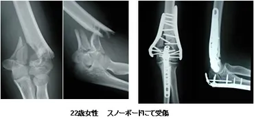 骨折のスピリチュアルな意味とは？：身体からのメッセージと人生への影響とは？骨折が示す人生の転換点：スピリチュアルな視点から読み解く